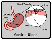 tajdrug_gastric-ulcers